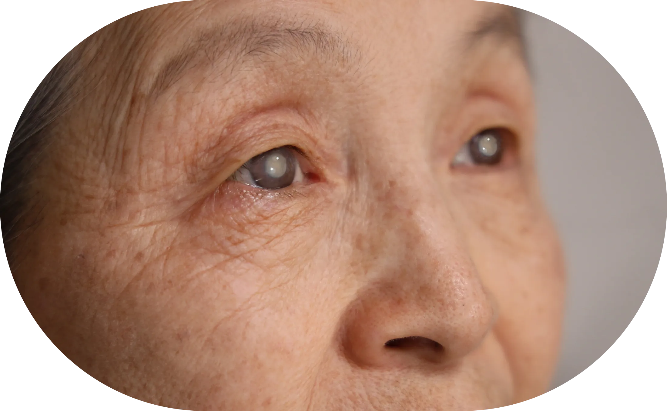 白内障手術をご希望の方